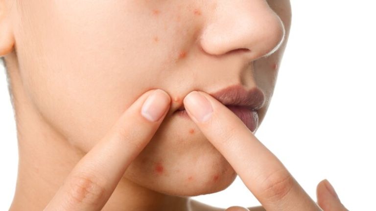 acne