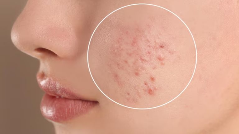 Pele com Acne